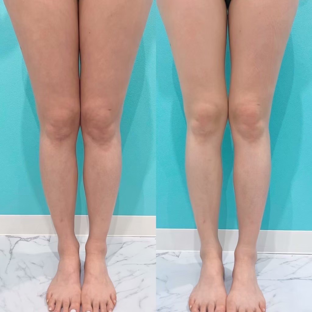 オンダリフト痩身