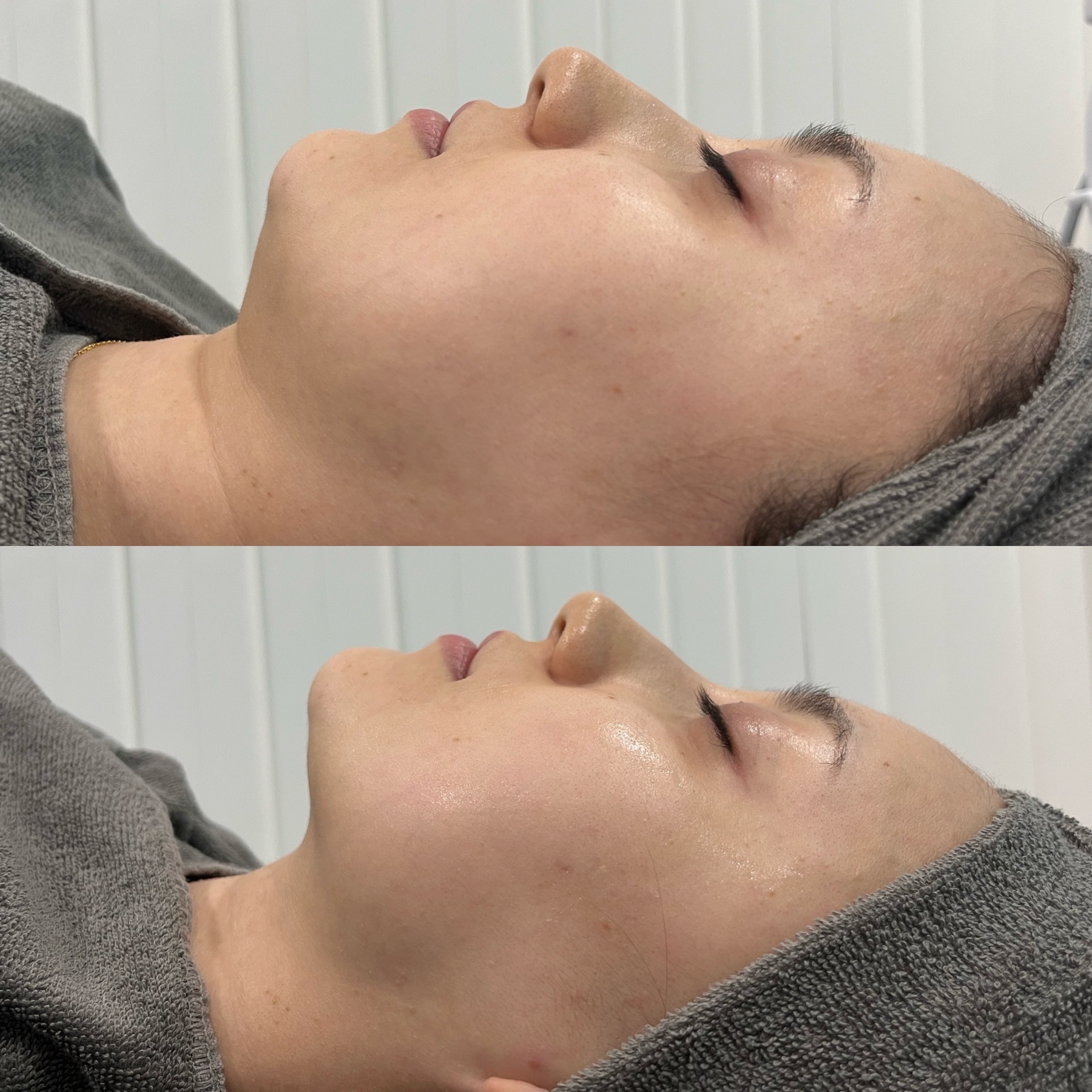 オンダリフト小顔